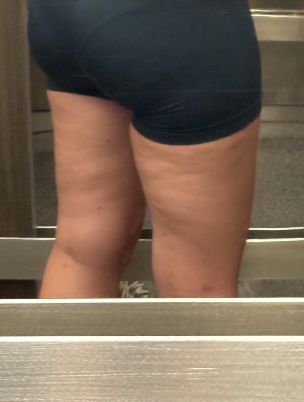 Before — dimpled, uneven legs